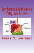 Very Common NonAlcoholic Fatty Liver Disease: How To Know if You Have Hepatic Steatosis